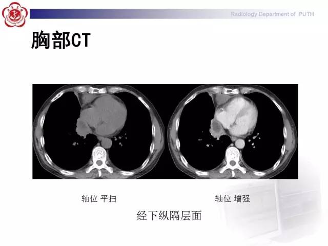 【病例】智齿诱发下行性坏死性纵隔炎1例CT