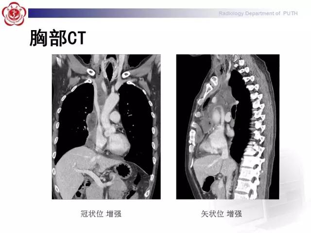 【病例】智齿诱发下行性坏死性纵隔炎1例CT