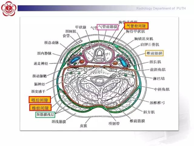 【病例】智齿诱发下行性坏死性纵隔炎1例CT