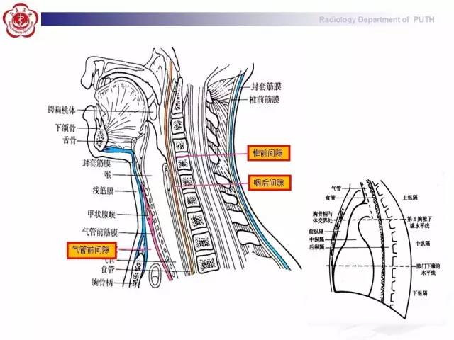 【病例】智齿诱发下行性坏死性纵隔炎1例CT