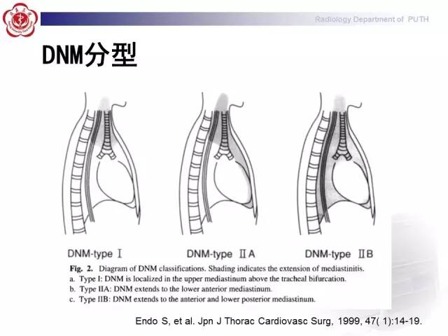 【病例】智齿诱发下行性坏死性纵隔炎1例CT