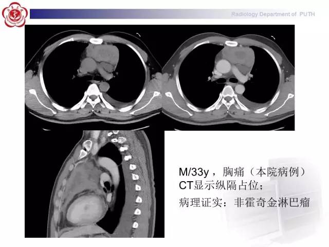 【病例】智齿诱发下行性坏死性纵隔炎1例CT