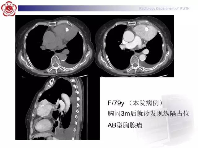 【病例】智齿诱发下行性坏死性纵隔炎1例CT