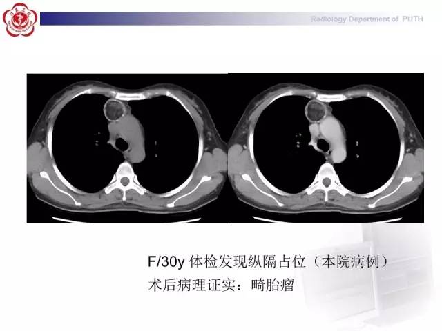 【病例】智齿诱发下行性坏死性纵隔炎1例CT