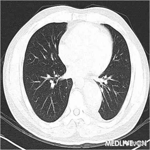 【病例】异位胸腺瘤1例CT影像表现 【病例】异位胸腺瘤1例CT影像表现