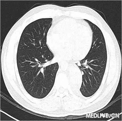 【病例】异位胸腺瘤1例CT影像表现 【病例】异位胸腺瘤1例CT影像表现