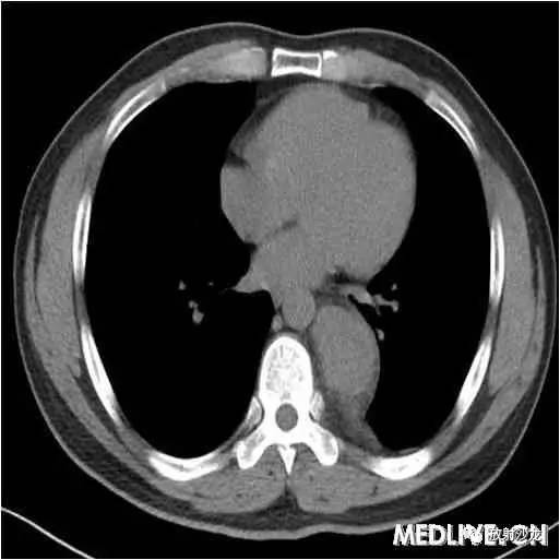 【病例】异位胸腺瘤1例CT影像表现 【病例】异位胸腺瘤1例CT影像表现