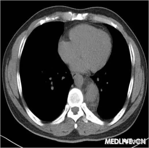 【病例】异位胸腺瘤1例CT影像表现 【病例】异位胸腺瘤1例CT影像表现