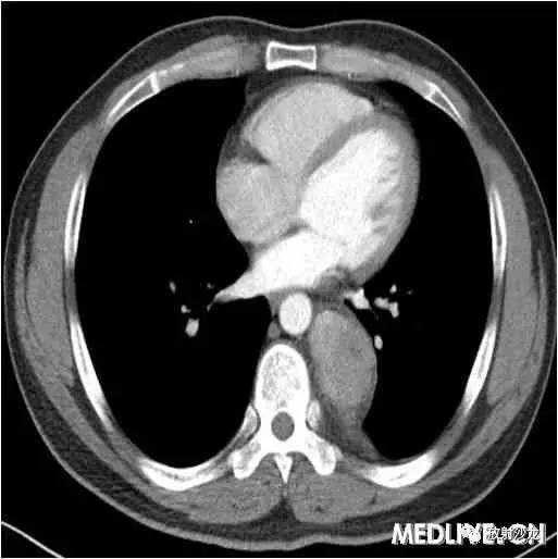 【病例】异位胸腺瘤1例CT影像表现 【病例】异位胸腺瘤1例CT影像表现