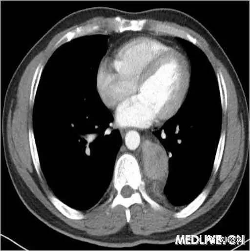 【病例】异位胸腺瘤1例CT影像表现 【病例】异位胸腺瘤1例CT影像表现