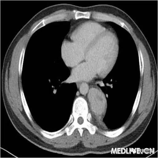 【病例】异位胸腺瘤1例CT影像表现 【病例】异位胸腺瘤1例CT影像表现