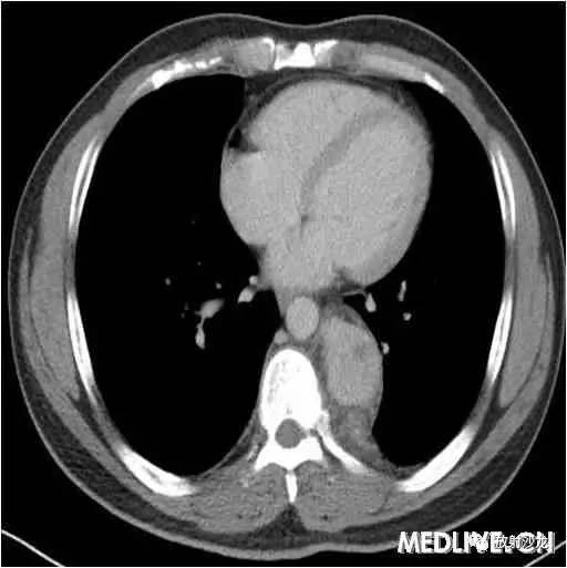 【病例】异位胸腺瘤1例CT影像表现 【病例】异位胸腺瘤1例CT影像表现
