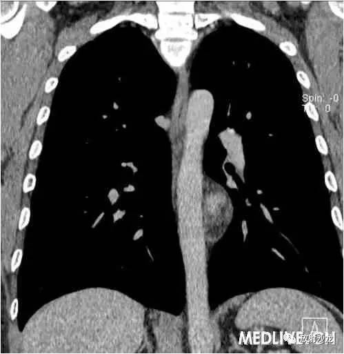 【病例】异位胸腺瘤1例CT影像表现 【病例】异位胸腺瘤1例CT影像表现