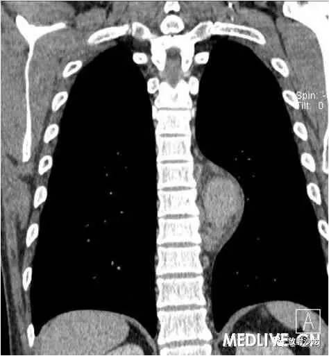 【病例】异位胸腺瘤1例CT影像表现 【病例】异位胸腺瘤1例CT影像表现
