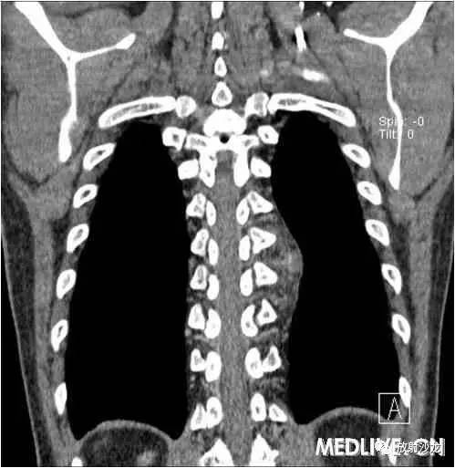 【病例】异位胸腺瘤1例CT影像表现 【病例】异位胸腺瘤1例CT影像表现