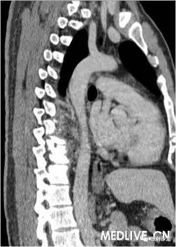 【病例】异位胸腺瘤1例CT影像表现 【病例】异位胸腺瘤1例CT影像表现