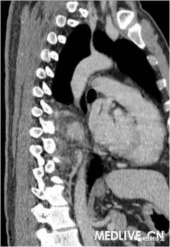 【病例】异位胸腺瘤1例CT影像表现 【病例】异位胸腺瘤1例CT影像表现