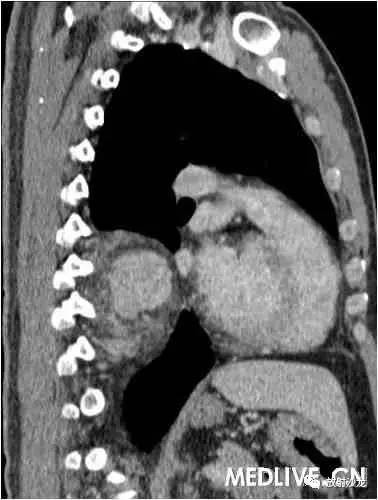 【病例】异位胸腺瘤1例CT影像表现 【病例】异位胸腺瘤1例CT影像表现