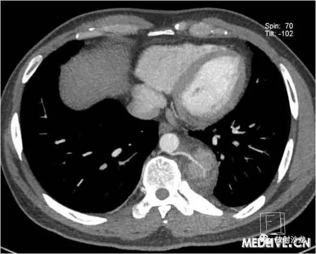 【病例】异位胸腺瘤1例CT影像表现 【病例】异位胸腺瘤1例CT影像表现