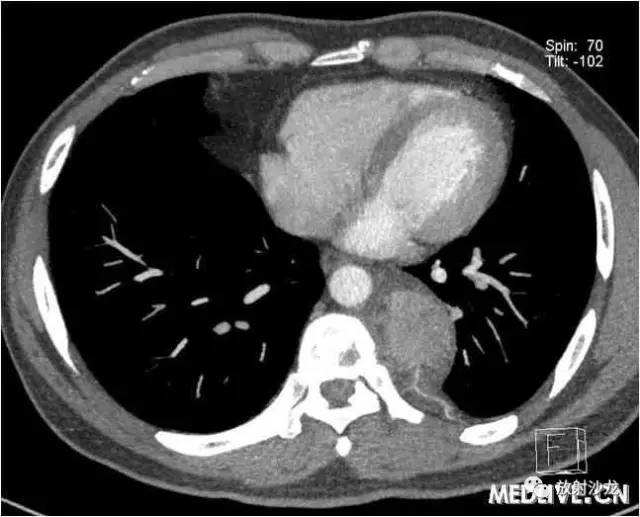 【病例】异位胸腺瘤1例CT影像表现 【病例】异位胸腺瘤1例CT影像表现