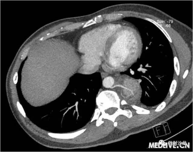 【病例】移位胸腺瘤1例CT影像表现