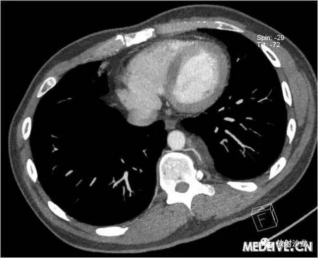 【病例】异位胸腺瘤1例CT影像表现 【病例】异位胸腺瘤1例CT影像表现