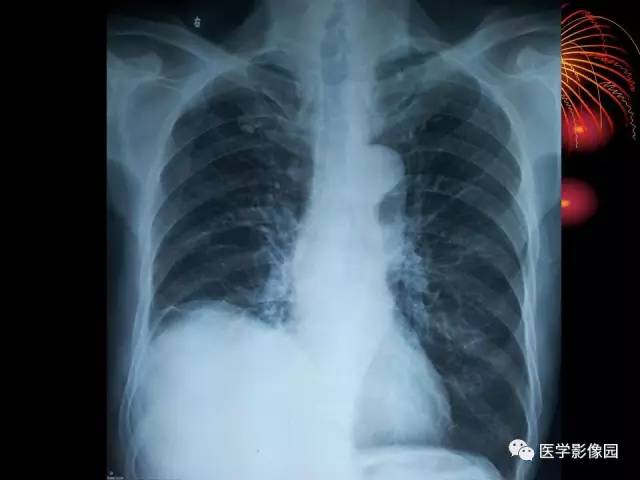 【病例】胸腔巨大孤立性纤维瘤1例CT 【病例】胸腔巨大孤立性纤维瘤1例CT