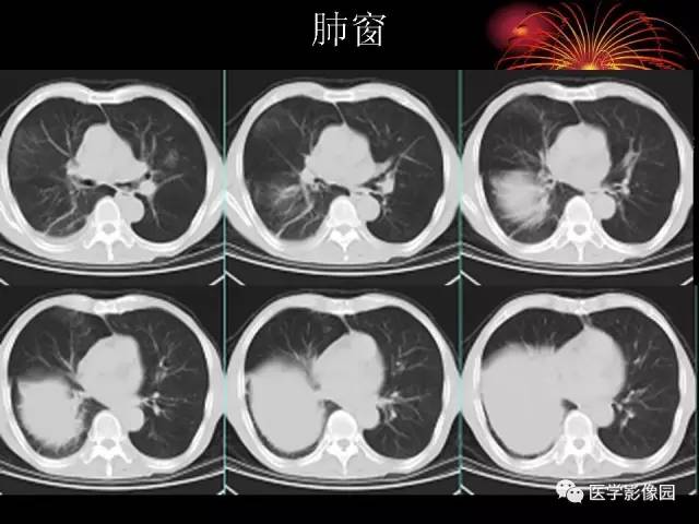 【病例】胸腔巨大孤立性纤维瘤1例CT 【病例】胸腔巨大孤立性纤维瘤1例CT