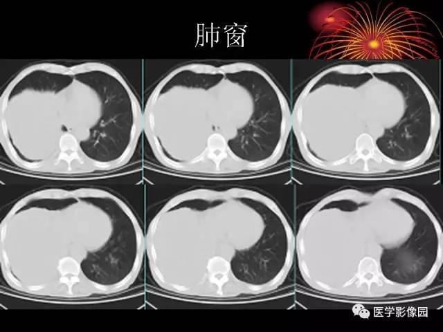 【病例】胸腔巨大孤立性纤维瘤1例CT 【病例】胸腔巨大孤立性纤维瘤1例CT