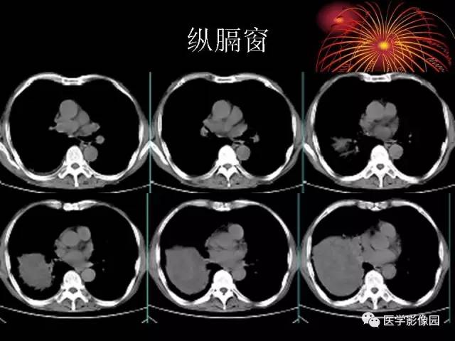 【病例】胸腔巨大孤立性纤维瘤1例CT 【病例】胸腔巨大孤立性纤维瘤1例CT