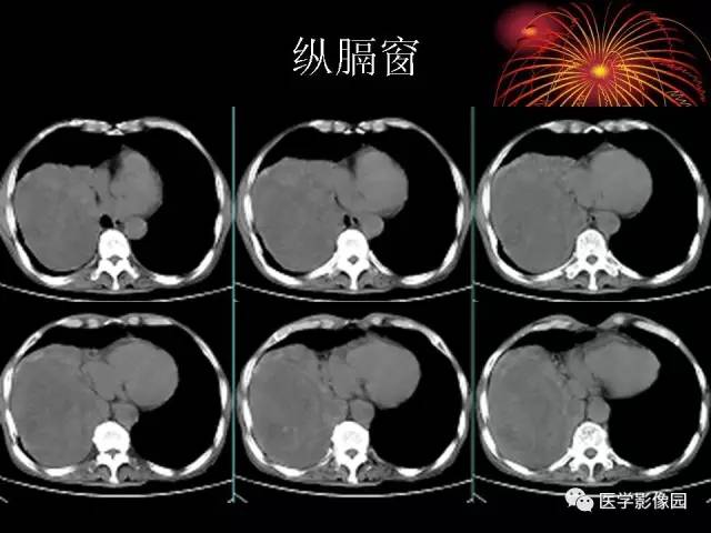 【病例】胸腔巨大孤立性纤维瘤1例CT 【病例】胸腔巨大孤立性纤维瘤1例CT