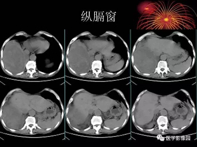 【病例】胸腔巨大孤立性纤维瘤1例CT 【病例】胸腔巨大孤立性纤维瘤1例CT
