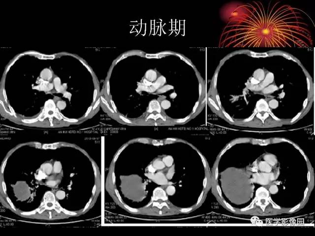 【病例】胸腔巨大孤立性纤维瘤1例CT 【病例】胸腔巨大孤立性纤维瘤1例CT