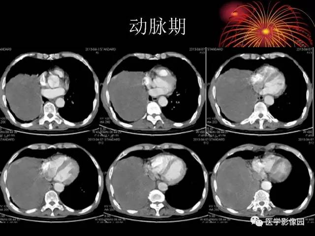【病例】胸腔巨大孤立性纤维瘤1例CT 【病例】胸腔巨大孤立性纤维瘤1例CT