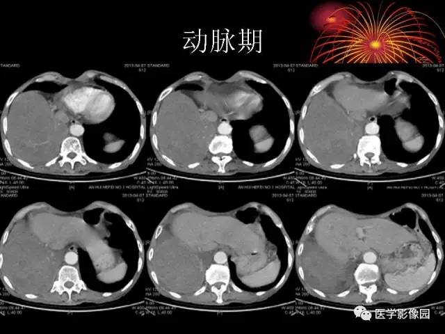 【病例】胸腔巨大孤立性纤维瘤1例CT 【病例】胸腔巨大孤立性纤维瘤1例CT
