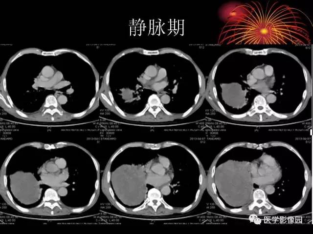 【病例】胸腔巨大孤立性纤维瘤1例CT 【病例】胸腔巨大孤立性纤维瘤1例CT