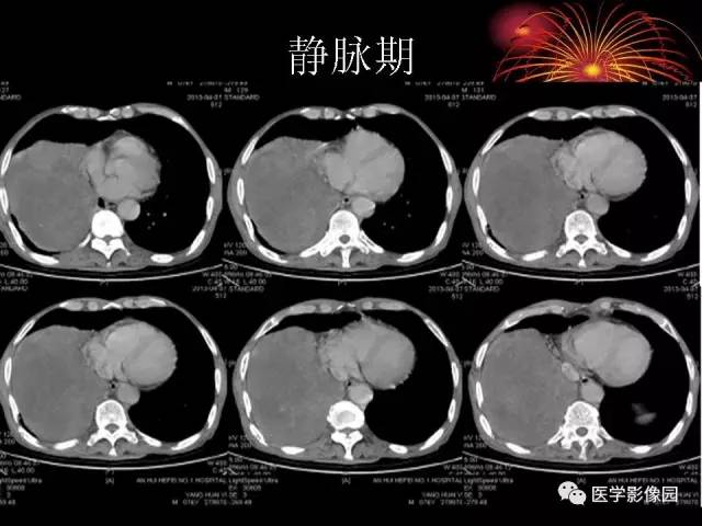 【病例】胸腔巨大孤立性纤维瘤1例CT