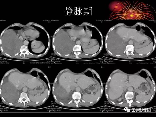【病例】胸腔巨大孤立性纤维瘤1例CT 【病例】胸腔巨大孤立性纤维瘤1例CT
