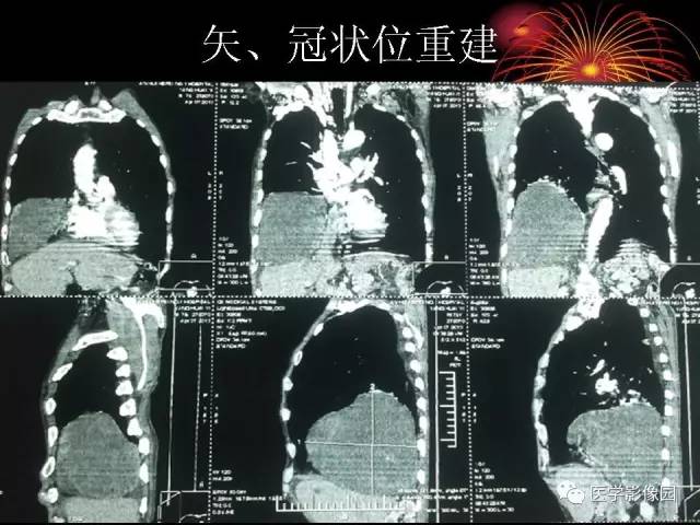 【病例】胸腔巨大孤立性纤维瘤1例CT 【病例】胸腔巨大孤立性纤维瘤1例CT