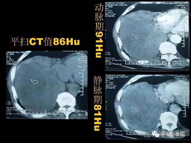 【病例】胸腔巨大孤立性纤维瘤1例CT 【病例】胸腔巨大孤立性纤维瘤1例CT