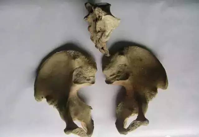 骶骨常见的解剖变异 骶骨常见的解剖变异