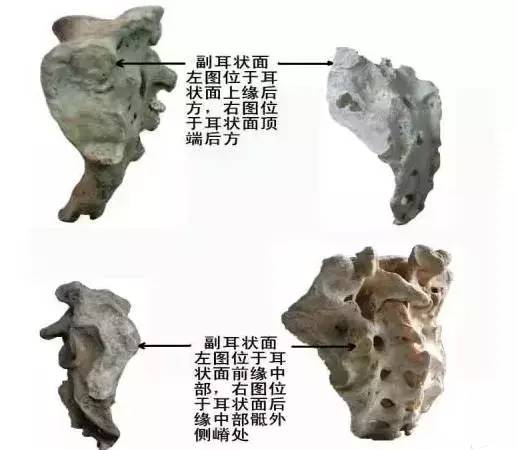 骶骨常见的解剖变异 骶骨常见的解剖变异