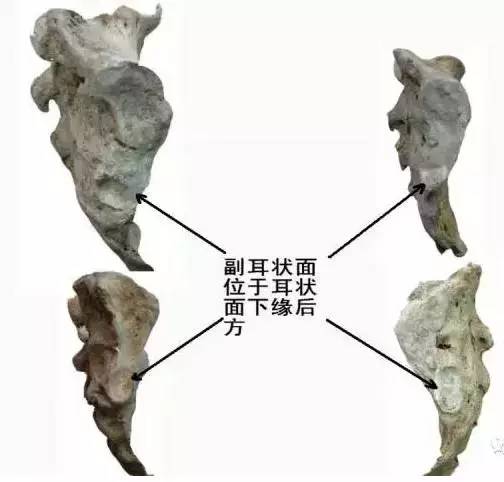 骶骨常见的解剖变异 骶骨常见的解剖变异