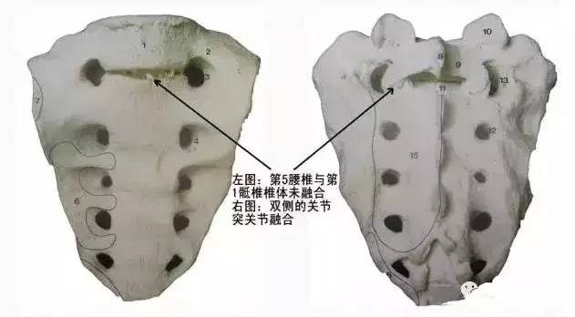 骶骨常见的解剖变异 骶骨常见的解剖变异