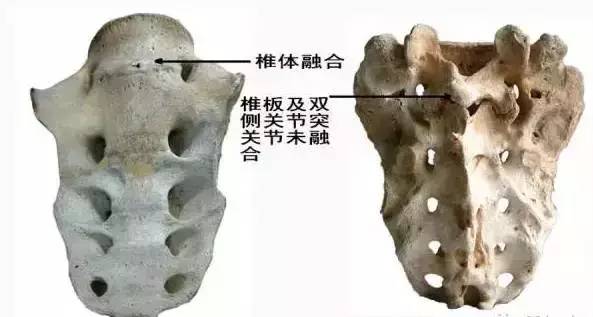 骶骨常见的解剖变异 骶骨常见的解剖变异
