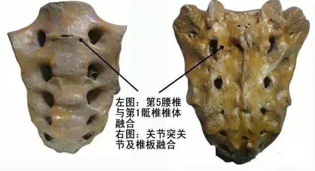骶骨常见的解剖变异 骶骨常见的解剖变异