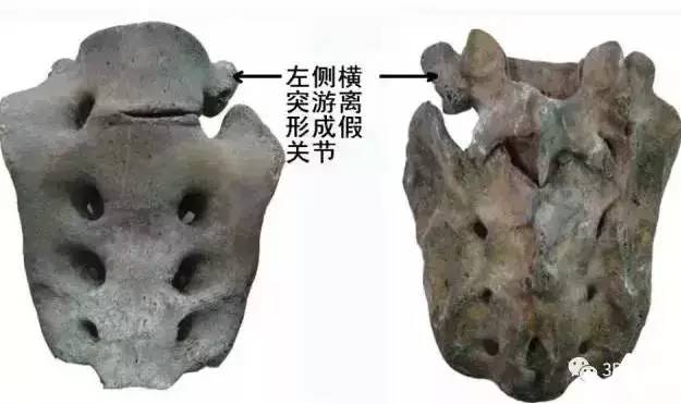 骶骨常见的解剖变异 骶骨常见的解剖变异