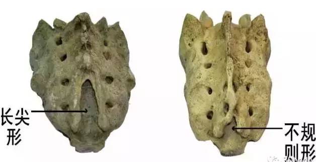 骶骨常见的解剖变异