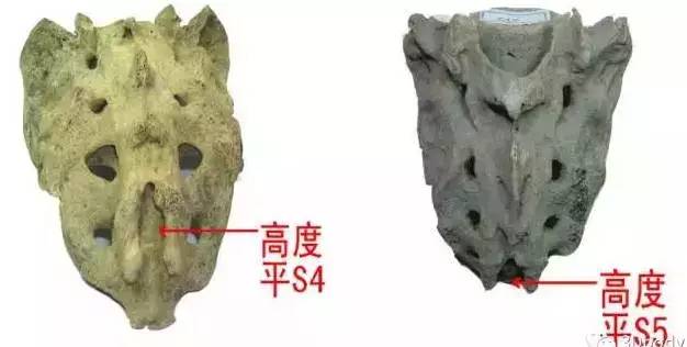 骶骨常见的解剖变异 骶骨常见的解剖变异