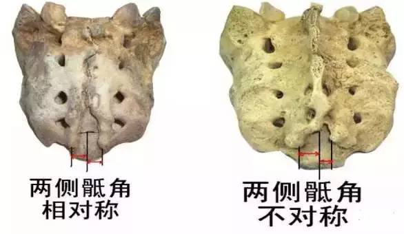 骶骨常见的解剖变异 骶骨常见的解剖变异